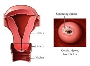 Cervical cancer