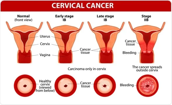 Cervical_Cancer